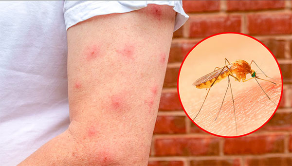 Muỗi đốt có thể gây ra những bệnh gì